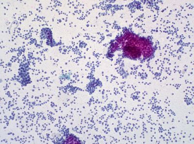 Komórki rakowe, foto-Ed Uthman, CC SA-BY 2.0